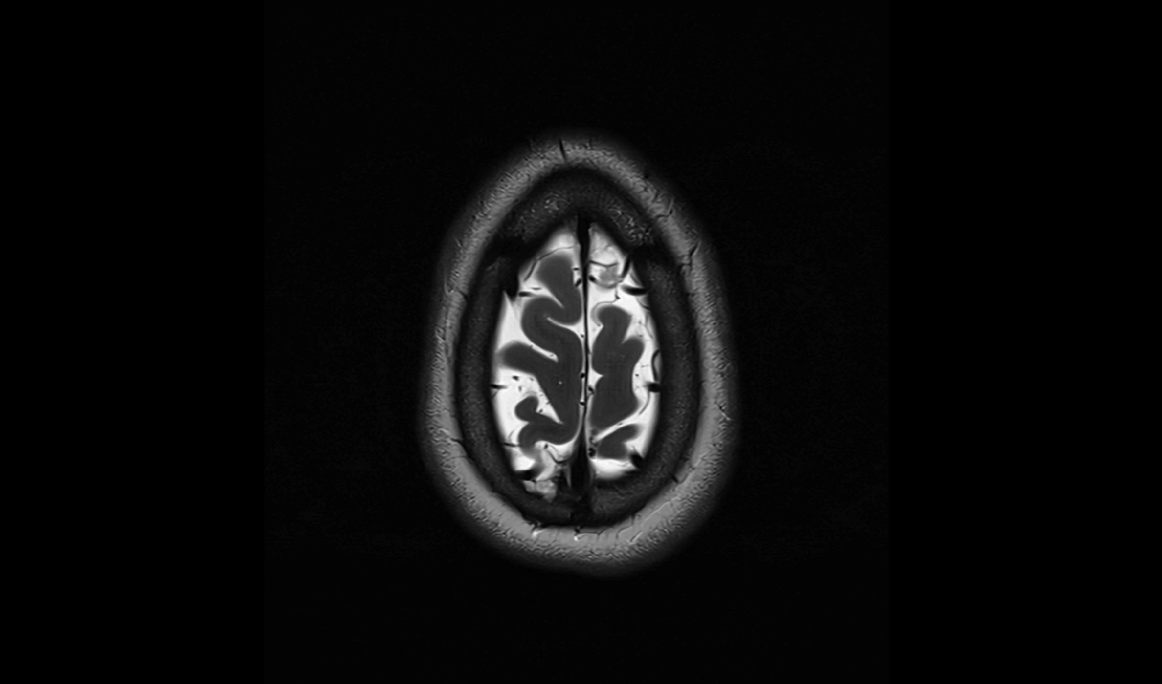 Brain cisterns  and ventricles  axial anatomy 3T MRI image-img-00001-00055.webp